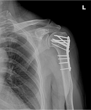 x-ray 사진