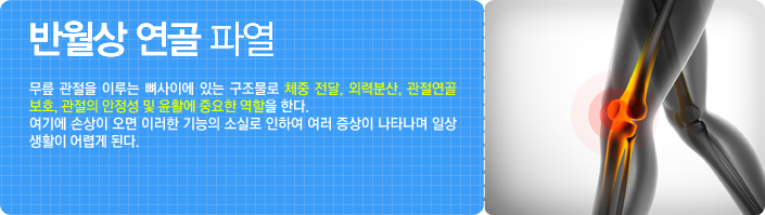 반월상 연골 파열