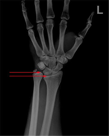 x-ray 사진