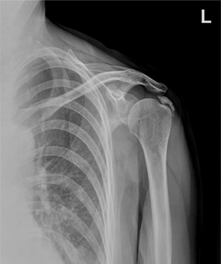 x-ray 사진